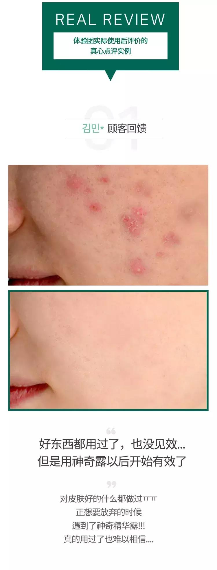 somebymi柚子精华可以祛痘印吗,茶树痘肌修复精华