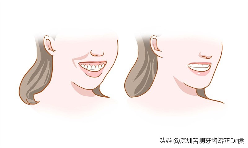 露龈笑怎么办,露龈笑矫正
