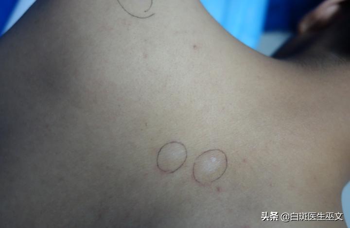 突发性白癜风治好了还会复发吗,白癜风好了一个月了没有症状