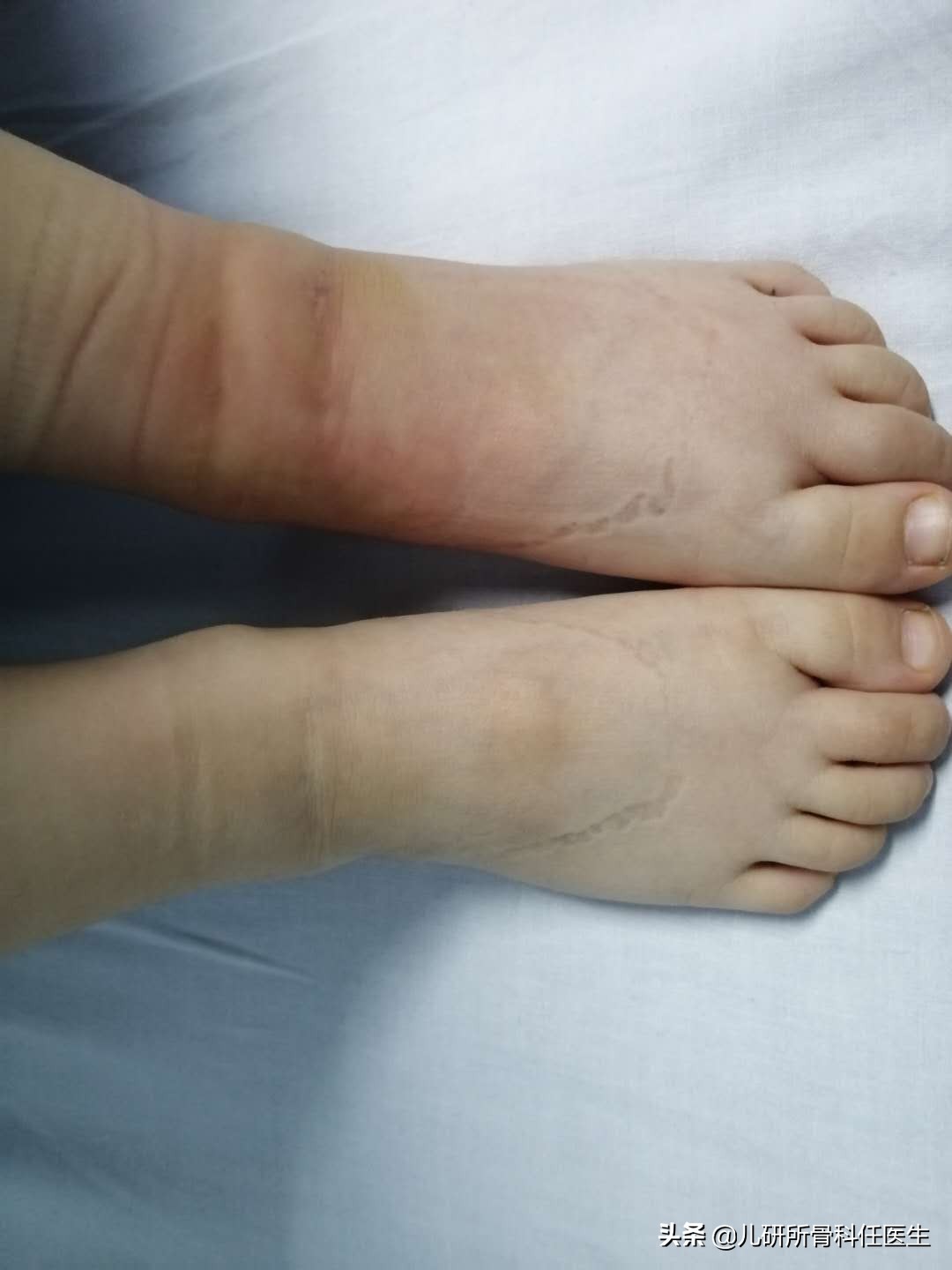 宝宝被蚊虫叮咬了怎么办,宝宝被蚊虫叮咬了用什么药