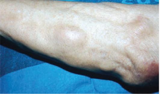 结节病关节痛眼睛模糊,结节病引起的关节炎