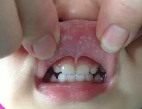 预防鹅口疮的最佳方法,如何预防婴幼儿鹅口疮