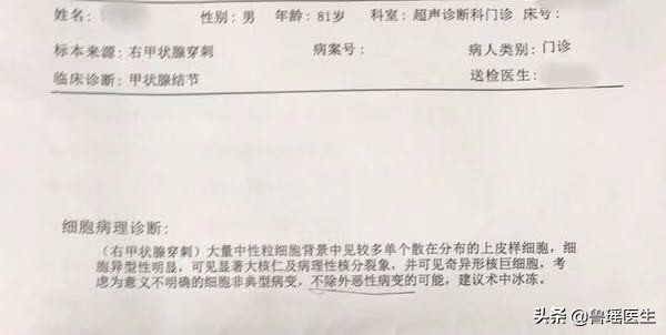 8旬老人甲状腺癌挤压气管向左侧移位术前评估中