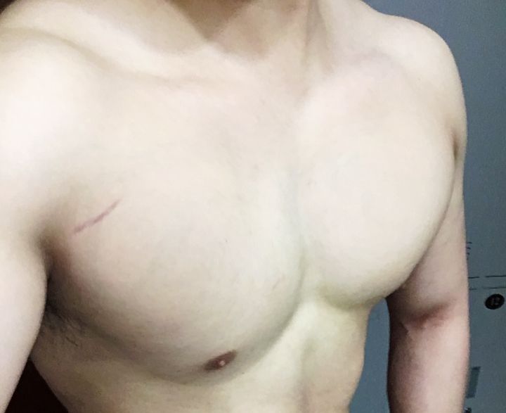 健身后肌肉上有红色纹路,健身后有条纹怎么回事