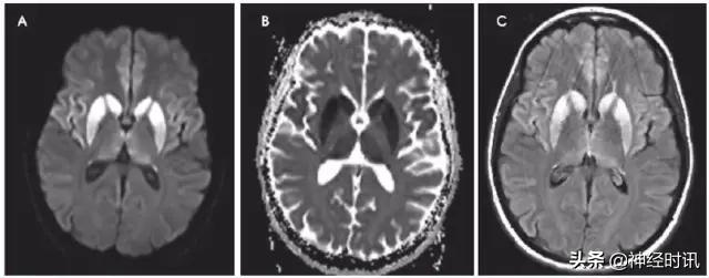 脑卒中的快速识别ppt,脑卒中神经影像学实例解析