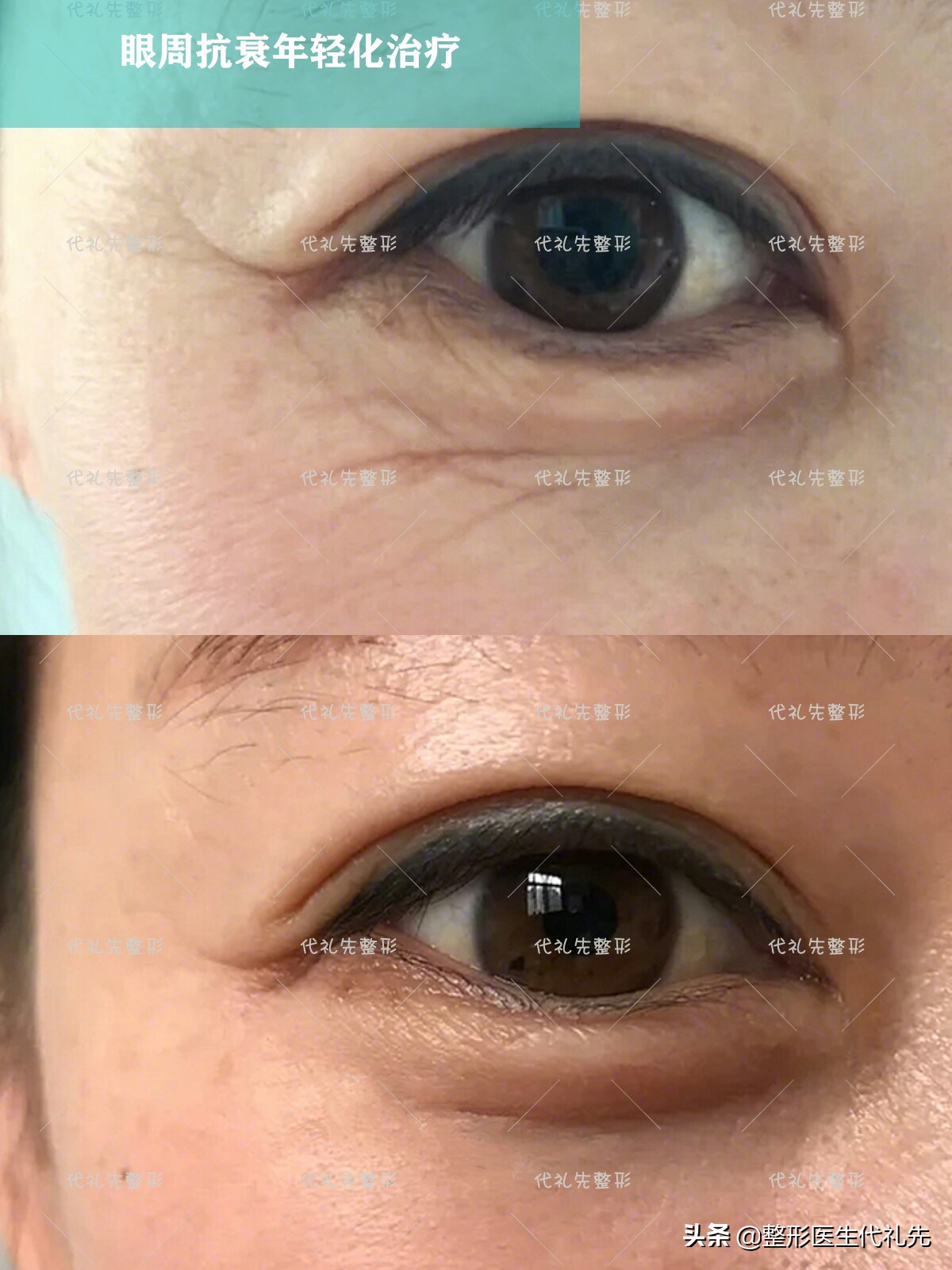 肉毒素最全讲解,肉毒素的十问