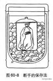 断肢再植科普图片,断肢再植属于几级手术