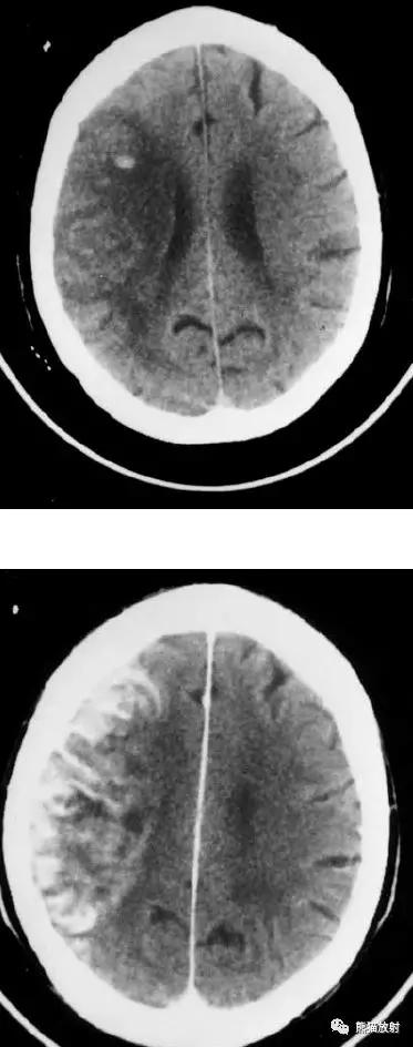 脑梗死丨演变、血供区域分布、CT表现