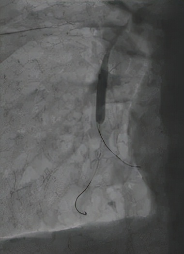 一个肠息肉切除干净后还会复发吗,肠息肉esd手术可以切除多大息肉