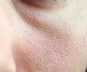 听说你毛孔大到可以放芝麻，该怎么办？