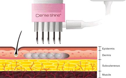 毛孔粗大抗炎,油脂性毛孔粗大怎么抗老