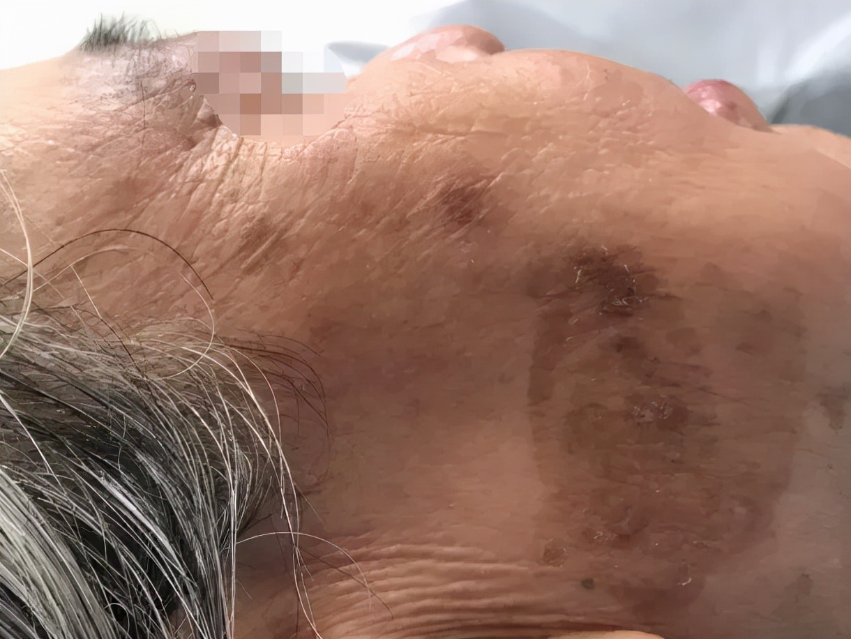 白癜风的正确看法,突然间长白癜风怎么回事