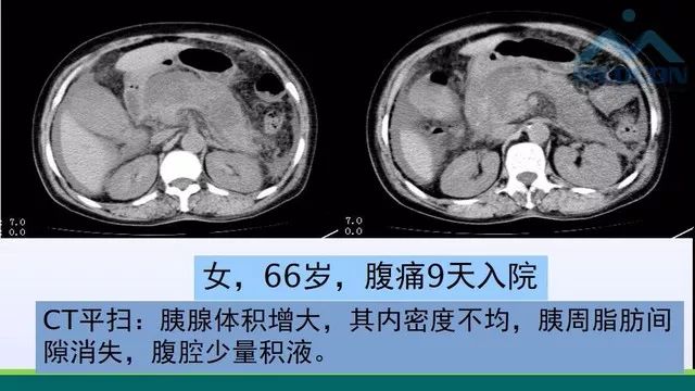 急性胰腺炎的护理措施,急性胰腺炎影像与临床