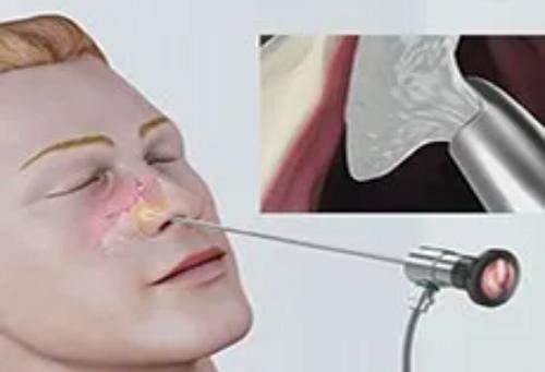 鼻息肉科普视频,健康科普带你了解什么是鼻息肉