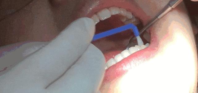 小孩换乳牙要换几颗乳牙,宝宝的乳牙只长一颗正常吗