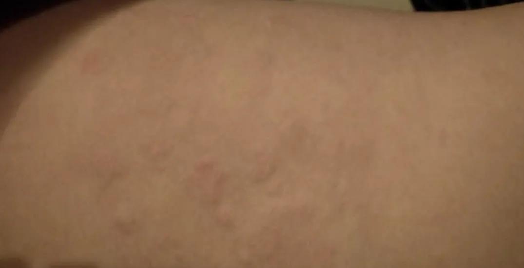 儿童得了过敏性荨麻疹很痒怎么办,儿童荨麻疹反复发作三招教你搞定