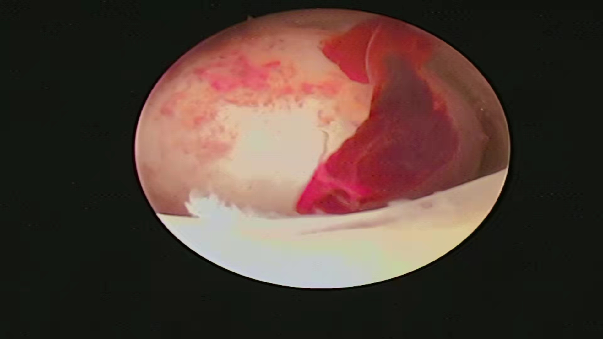 子宫肌瘤是不是必须做手术,子宫肌瘤做微创好还是手术开刀好