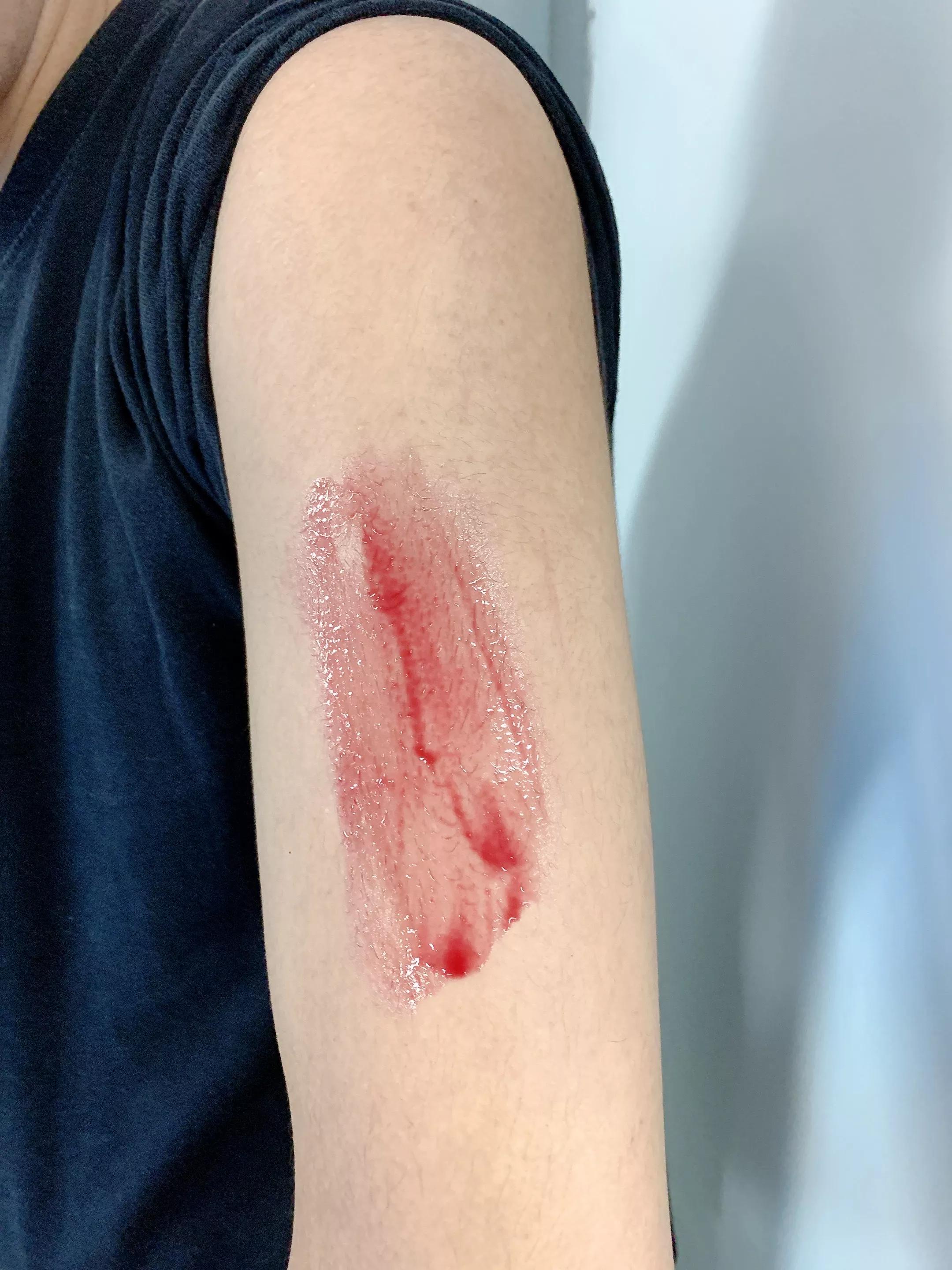 男朋友手臂长小疙瘩是什么原因,男朋友手臂上很多小痘痘是什么