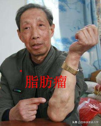 痰在肺则咳痰在胃则呕的意思,肺痰与胃痰