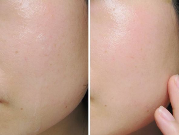 烟酰胺会烂脸吗,为什么抹了烟酰胺越来越黑