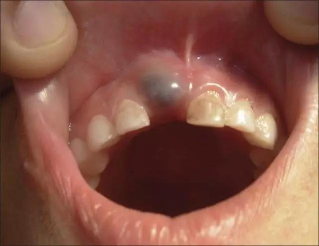 小孩长牙牙龈肿了怎么办,孩子长牙牙龈肿痛怎么办