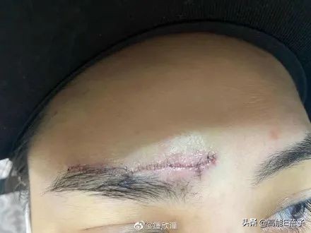 阿娇额头伤口恢复过程,阿娇晒伤口恢复照