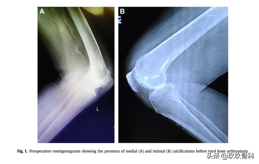 髋膝关节文献精译荟萃