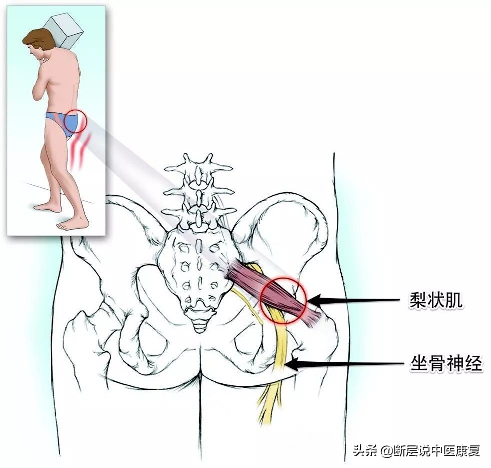怎样才能治好梨状肌综合征,如何治疗梨状肌综合征