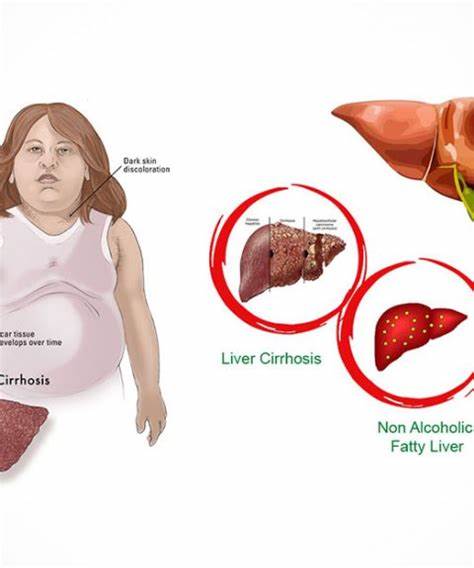 b超查出有脂肪肝怎么办,b超看出有脂肪肝但是肝功能正常