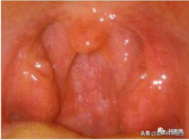 咽喉疾病科普知识,咽喉疾病动画科普视频