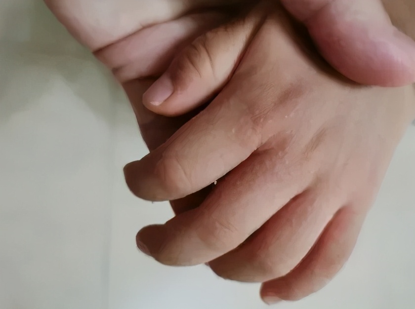 天一热手上就起一层小疙瘩还很痒,两只手上长密集的小疙瘩很痒很红