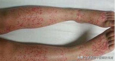 过敏性紫癜出现紫点,出血性紫斑跟过敏性紫癜有啥区别