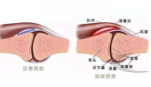 痛风石能挤碎吗,痛风石破溃后能自行愈合吗