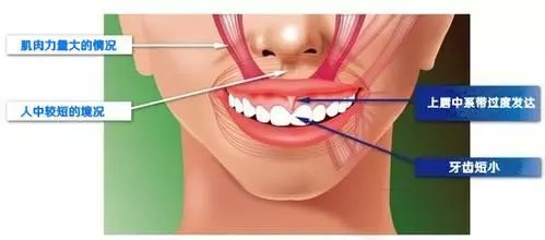 露龈笑太丑了该怎么办,露龈笑除了戴牙套有别的办法吗