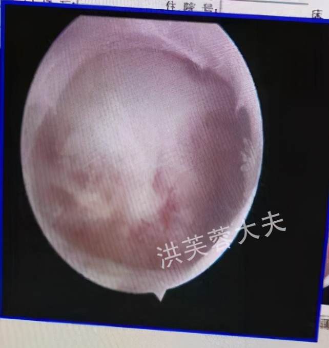 宫腔造影输卵管微创手术,宫腔粘连盆腔积液做宫腹腔镜手术