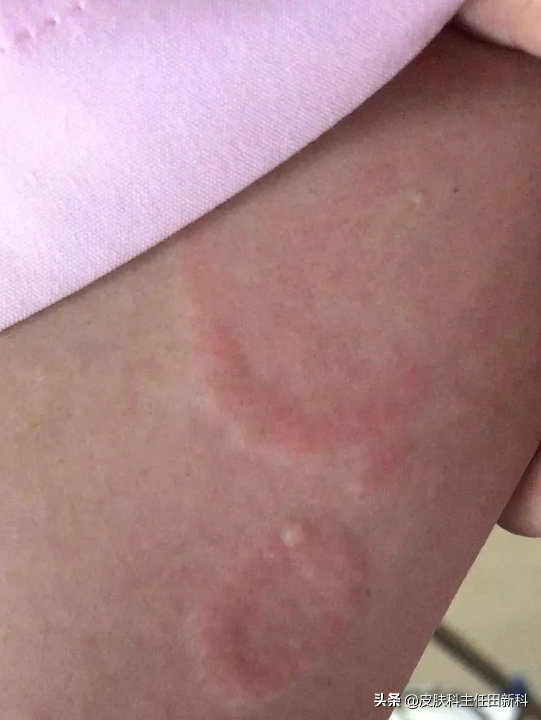 痘印变成斑点怎么治,痘印的种类以及成因你了解多少