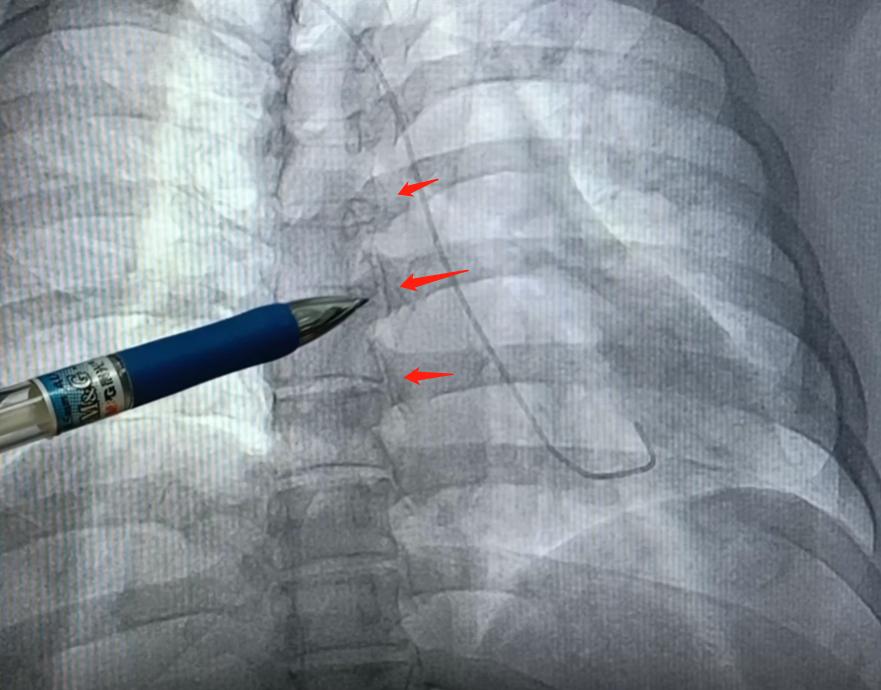 胸痛排除肺和心脏还能是什么病,胸痛排除心脏病