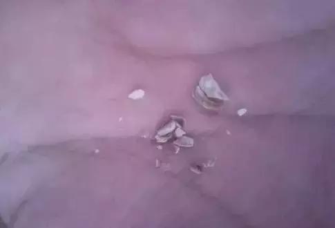 深度洗牙和普通洗牙,洗牙深度洁治和上药大概多少钱