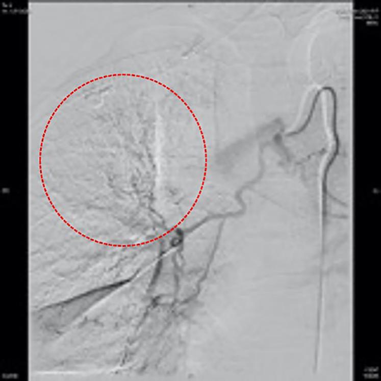 「梦里与丈夫吵架」醒来后咯血，是什么导致了她右侧支气管阻塞？