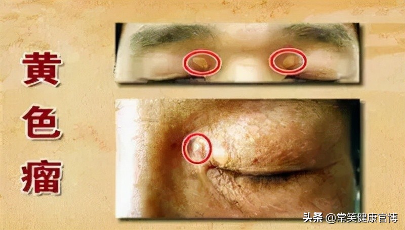 得了高胆固醇血症怎么办,高胆固醇血症有五个表现症状