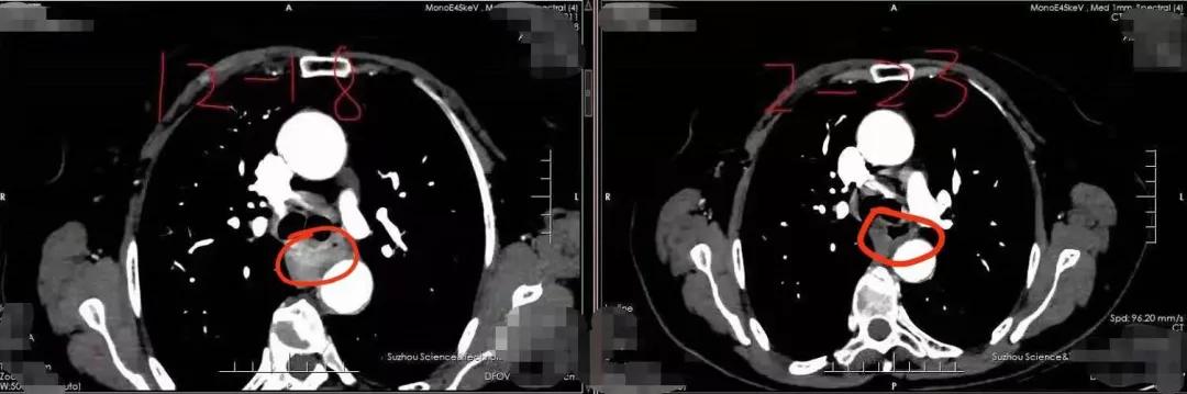 食管癌新辅助免疫治疗,食管癌化疗和免疫治疗后肿瘤变小