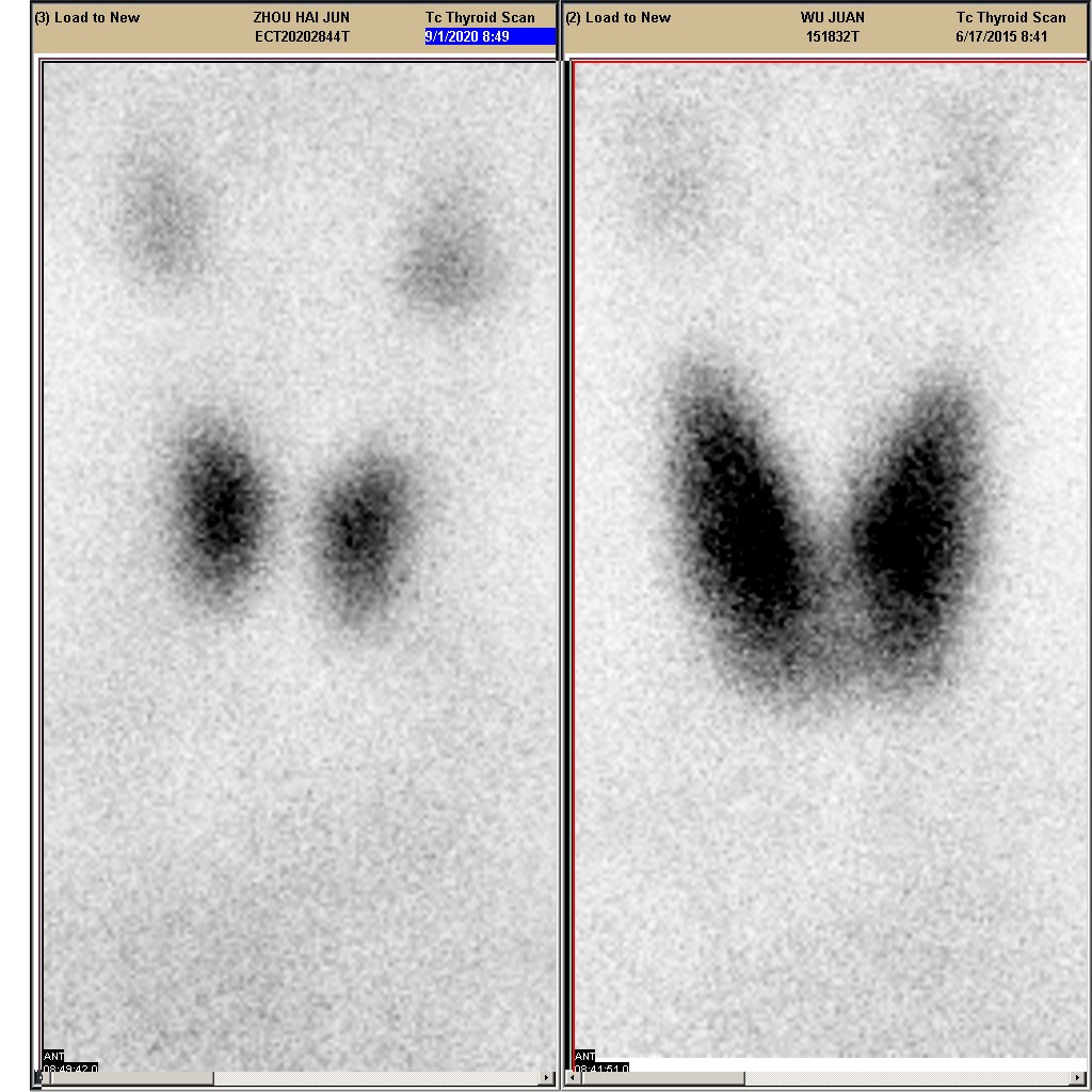 得了甲亢被同学嘲笑怎么办,被同学嫌弃的学生特点