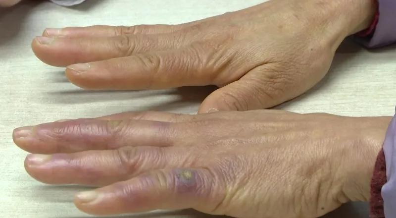 冬天冷的手变白怎么回事,冬天冷手指发白怎么回事