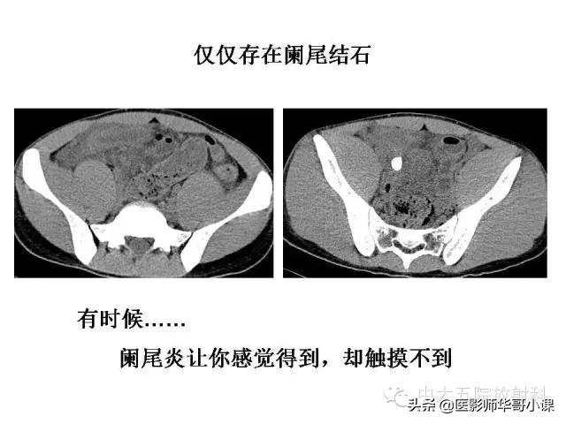 阑尾炎课件,阑尾炎的超声课件