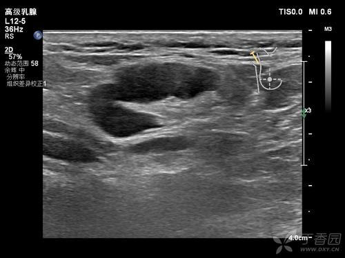 副乳里面有硬块要切除吗,副乳在腋窝下存在什么风险