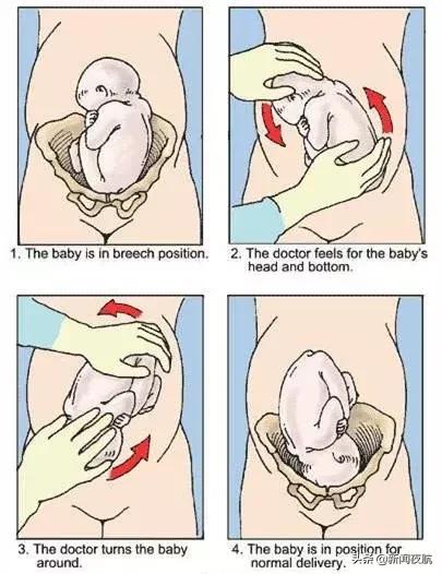 胎位不正乾坤大挪移视频,医生妙手10秒转胎头助力顺产