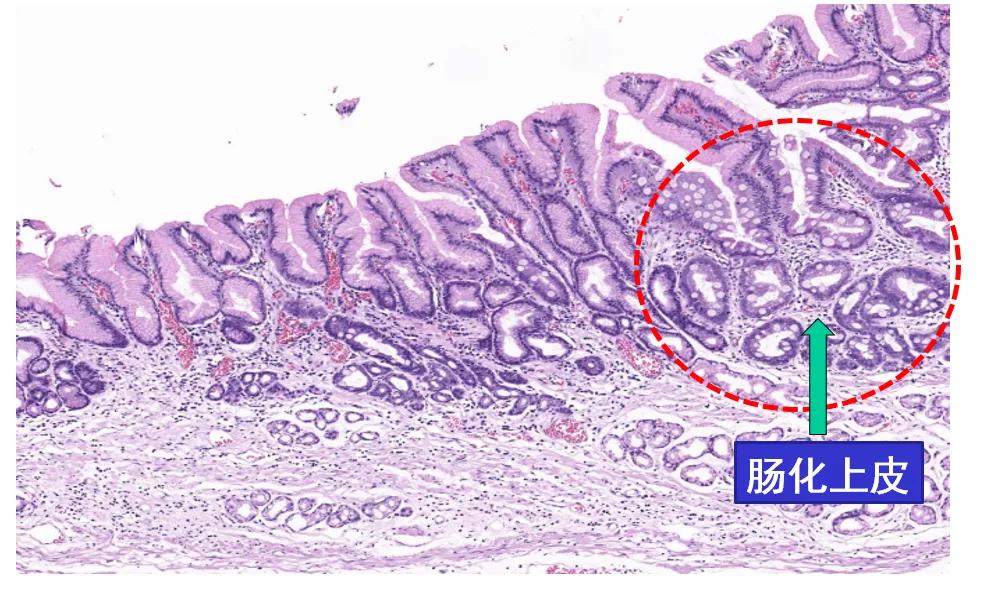 肠上皮化生是癌症吗,肠上皮化生什么意思
