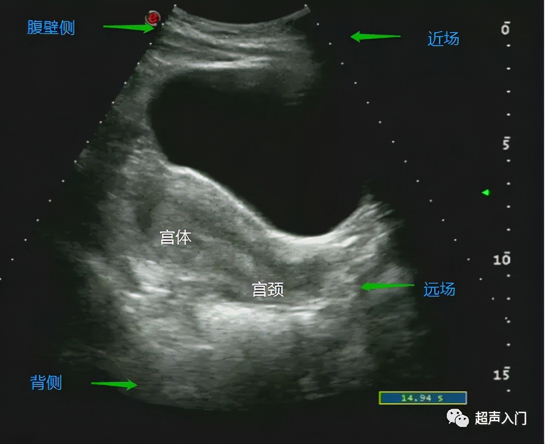 超声如何判断子宫位置,超声上怎么判断子宫后位