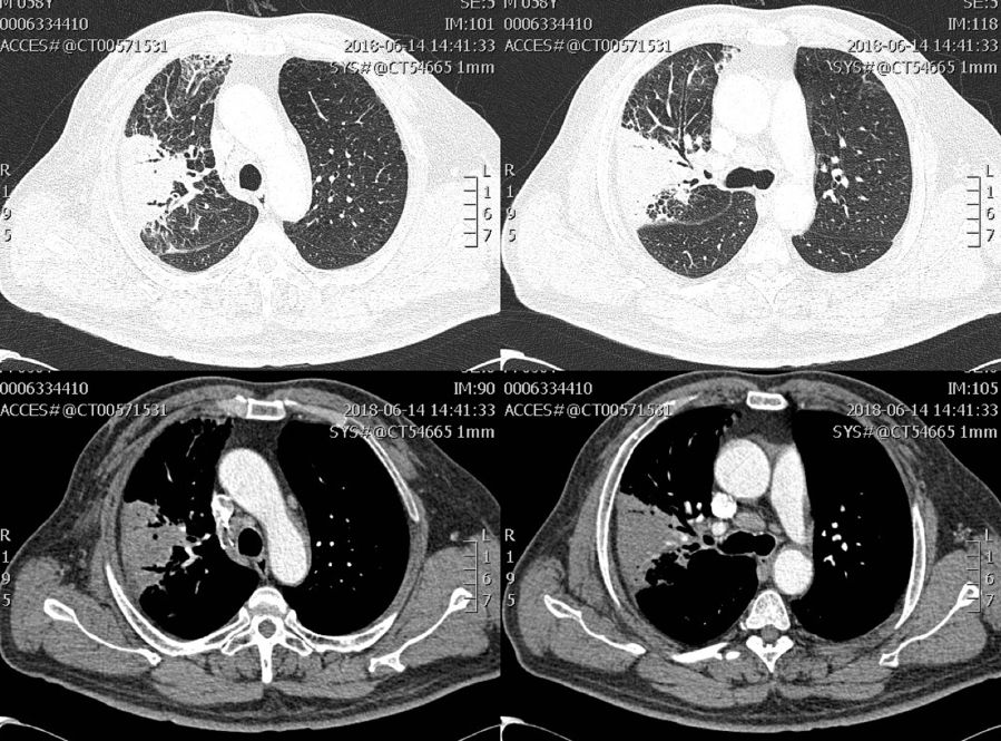 慢阻肺患者合并真菌感染,慢阻肺和真菌定植有关系吗