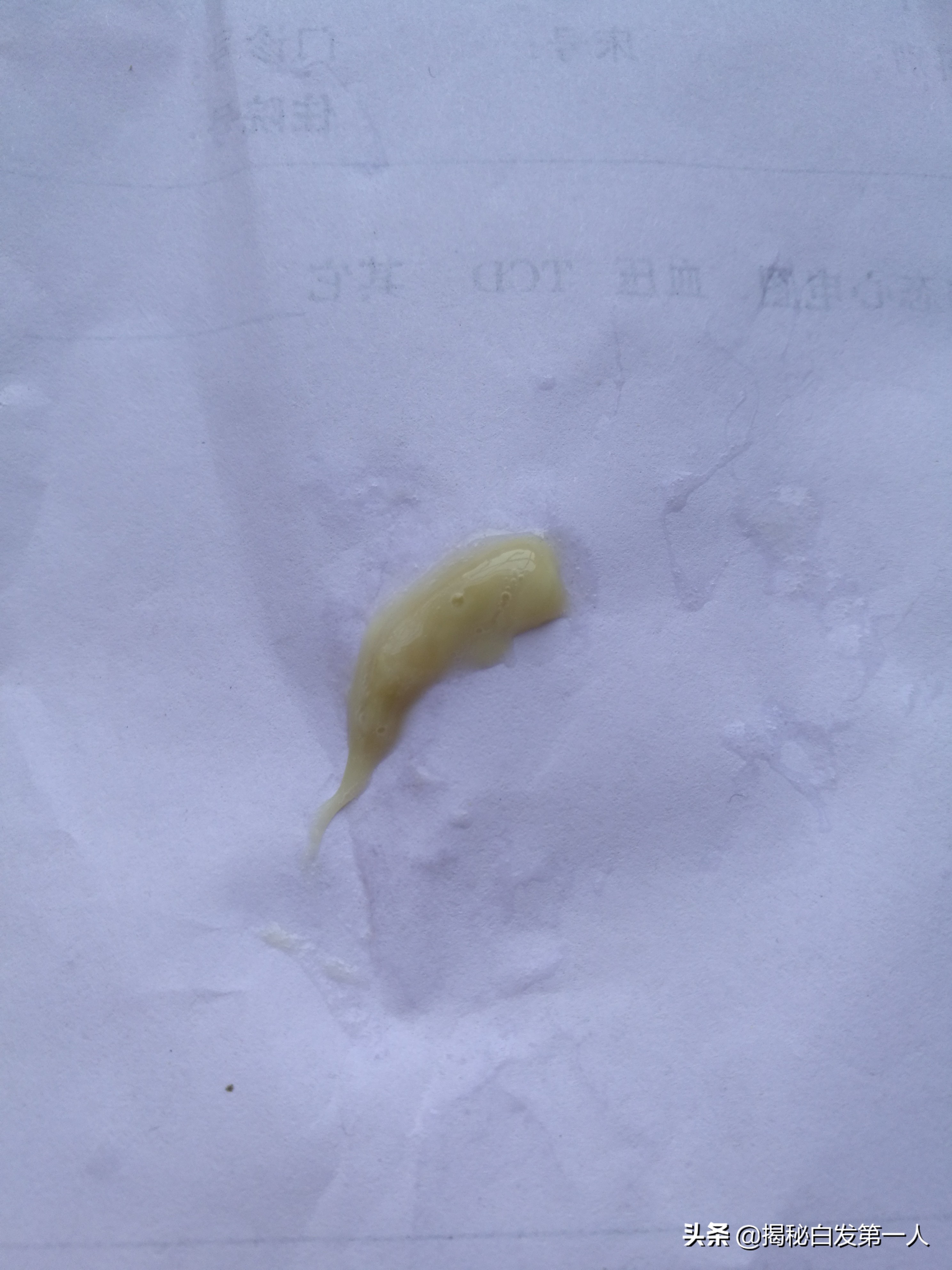 为什么会有黄痰排出,为什么会有黄痰呢